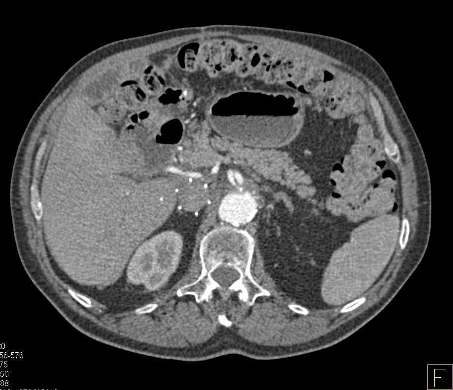 Inflammatory Changes Post Aneurysm Repair - CTisus CT Scan