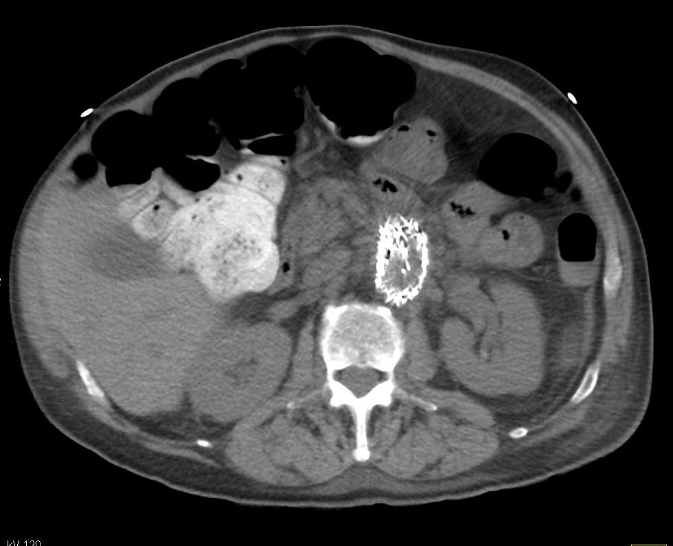 Post Aneurysm Repair with Fistulae to Bowel - CTisus CT Scan