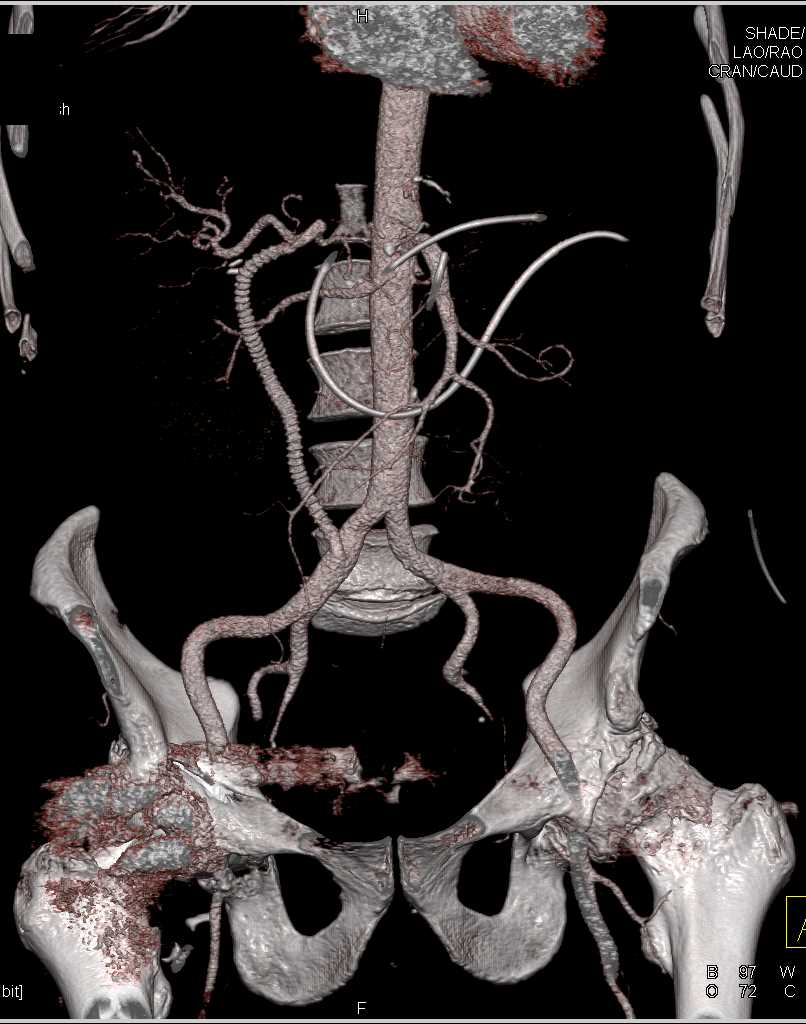 Vascular Bypass Grafting - CTisus CT Scan