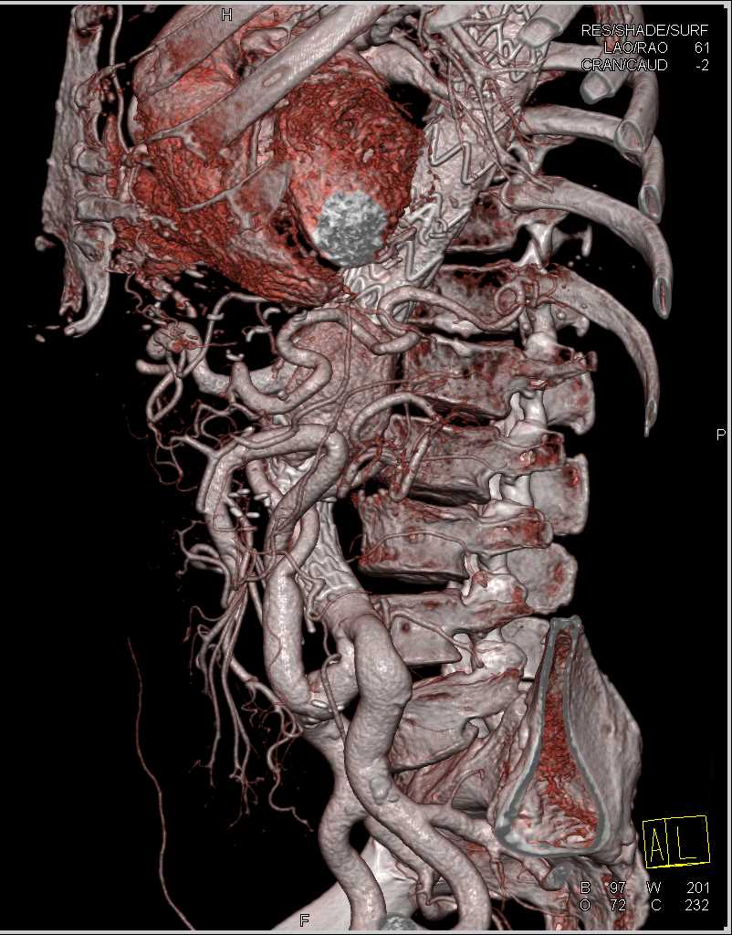 Aortic Repair with Grafts - CTisus CT Scan