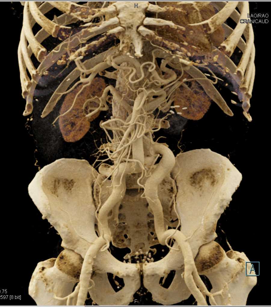 Bypass Grafting to the Superior Mesenteric Artery (SMA) - CTisus CT Scan