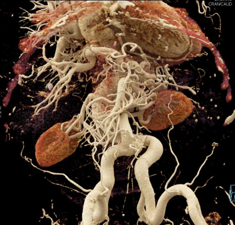 Bypass Grafting to the Superior Mesenteric Artery (SMA) - CTisus CT Scan