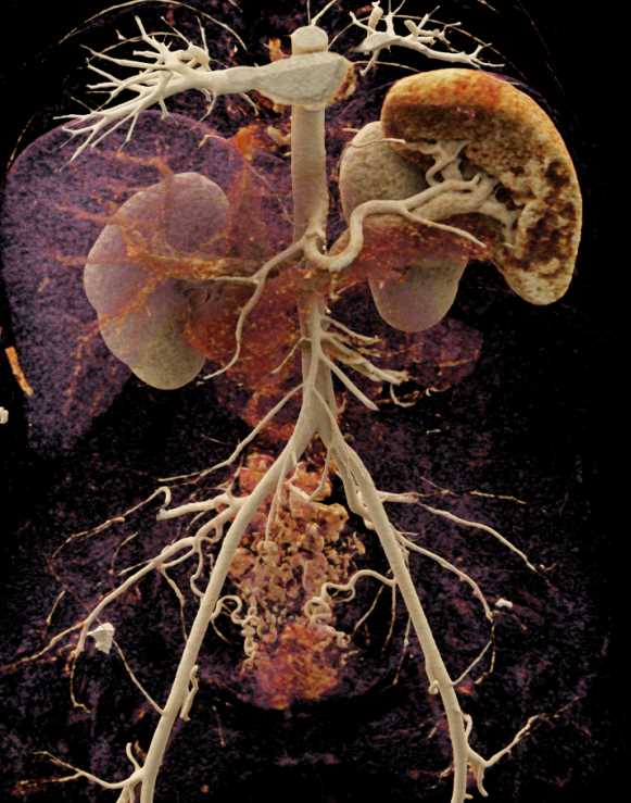 Vascular Mapping of the Aorta and Branching with Cinematic Rendering - CTisus CT Scan