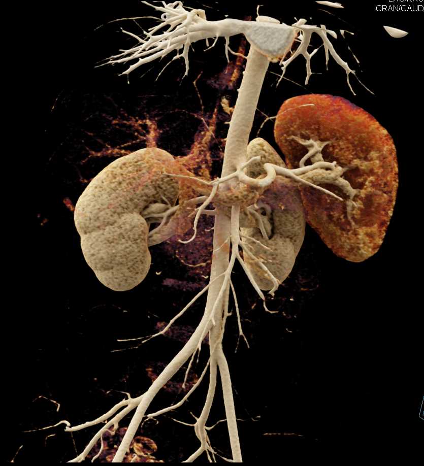 Vascular Mapping of the Aorta and Branching with Cinematic Rendering - CTisus CT Scan