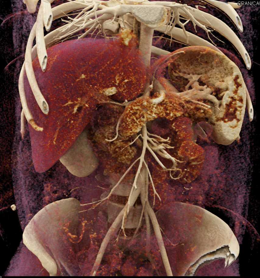 Vascular Mapping of the Aorta and Branching with Cinematic Rendering - CTisus CT Scan