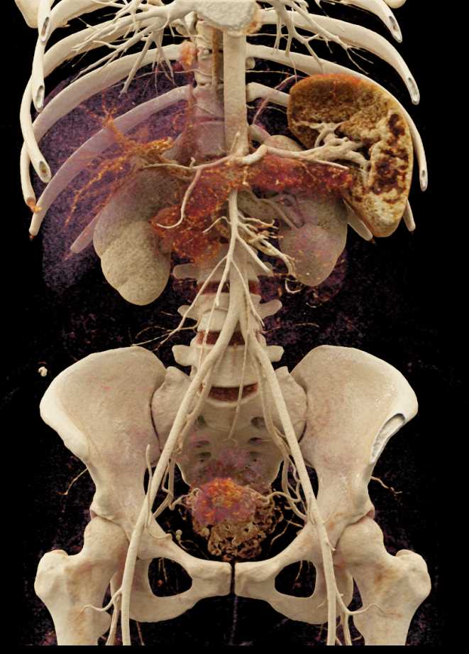 Superior Mesenteric Artery (SMA) and Celiac Axis with Cinematic Rendering - CTisus CT Scan