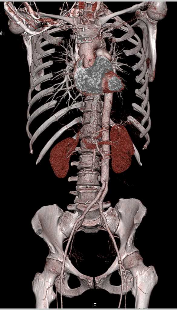 Occluded Left Graft - CTisus CT Scan