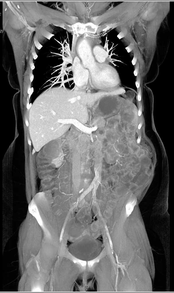 Occluded Left Graft - CTisus CT Scan