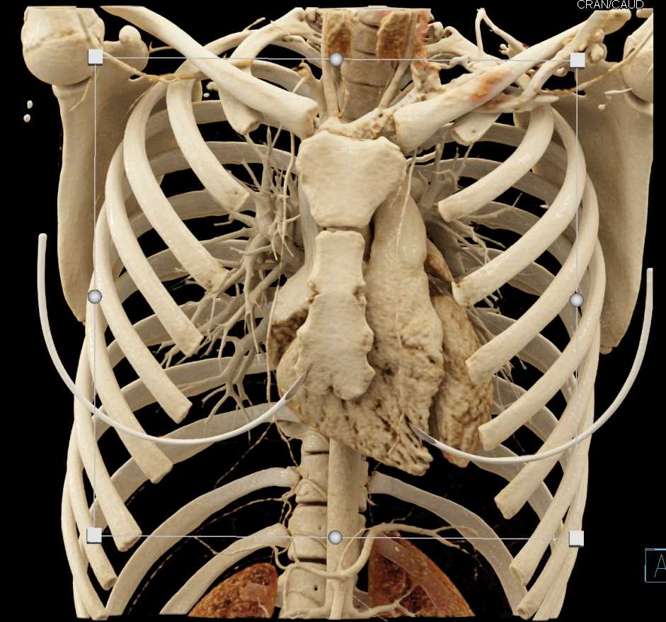 Cinematic Rendering of the Heart and Aorta - CTisus CT Scan