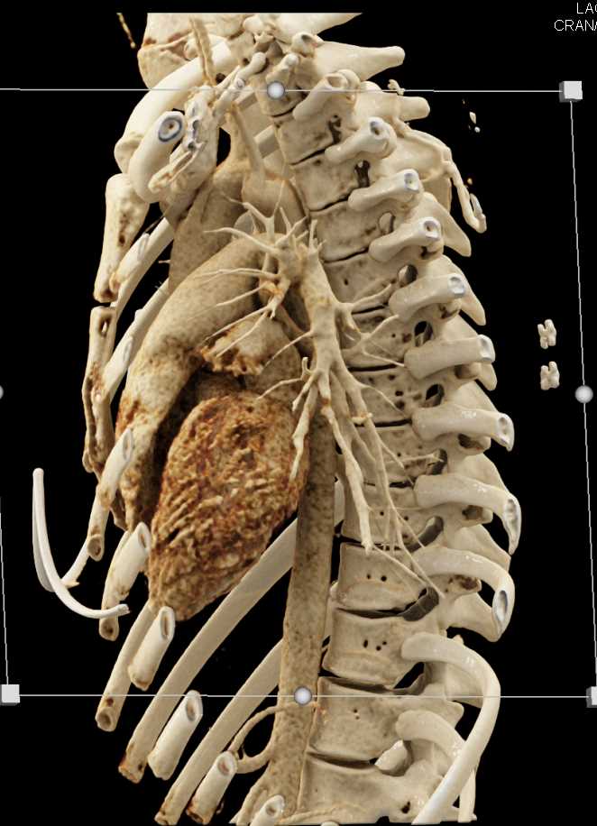 Cinematic Rendering of the Heart and Aorta - CTisus CT Scan