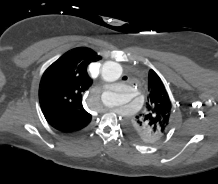 Type B Dissection - CTisus CT Scan