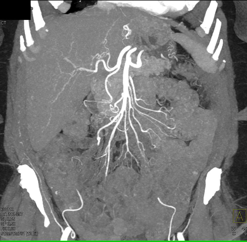 Small Aneurysm Ileal Branch of Superior Mesenteric Artery (SMA) - CTisus CT Scan