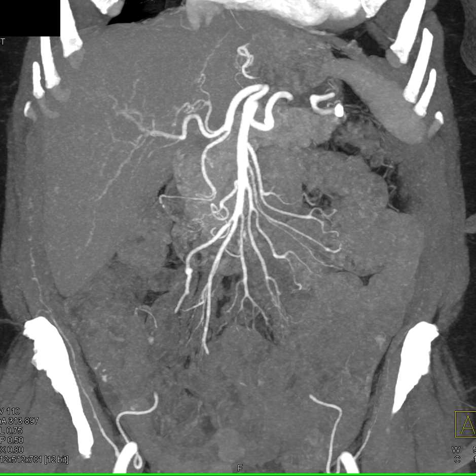 Small Aneurysm Ileal Branch of SMA - CTisus CT Scan
