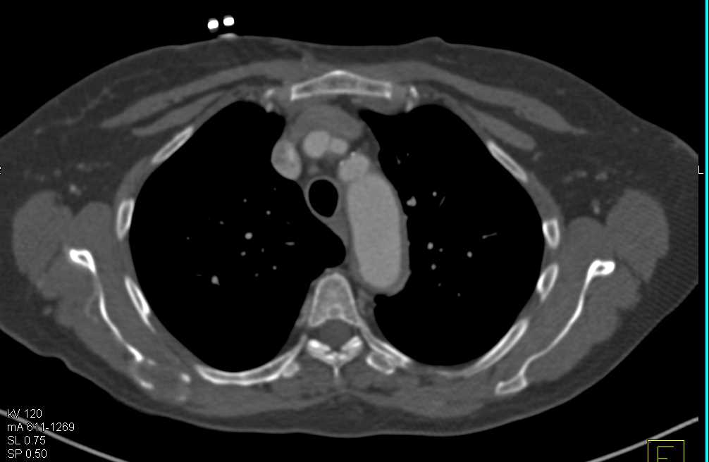 Dissection Descending Thoracic Aorta - CTisus CT Scan