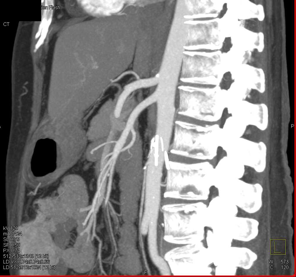 Vasculitis Involves the Superior Mesenteric Artery (SMA) - CTisus CT Scan