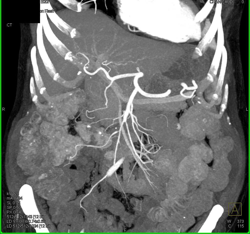 Vasculitis Involves the Superior Mesenteric Artery (SMA) - CTisus CT Scan