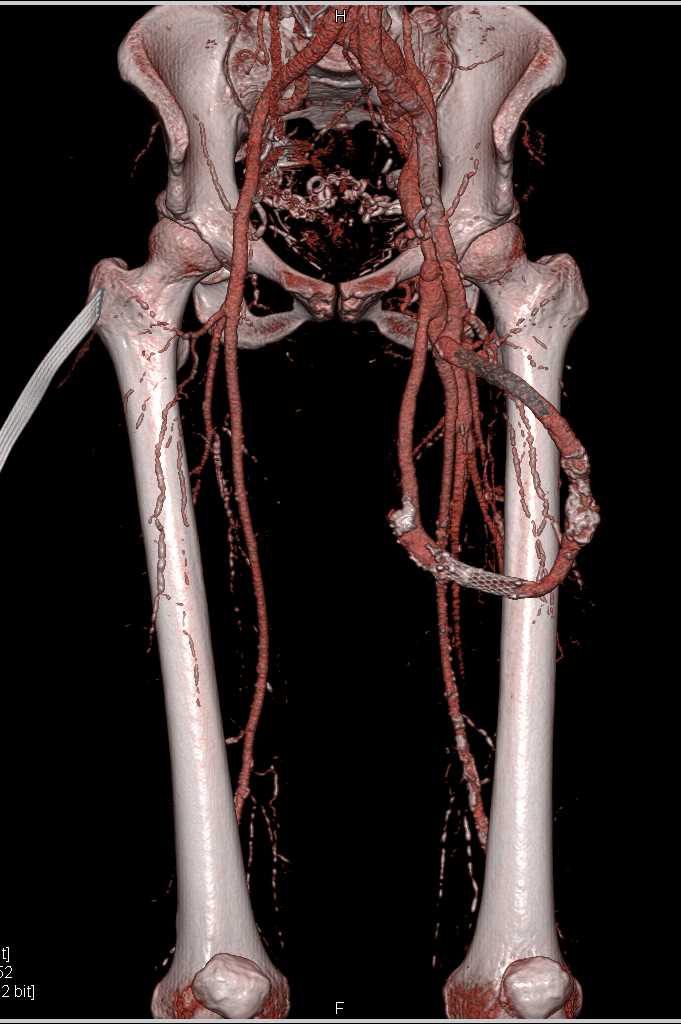 AV Shunt in Upper Left Thigh - CTisus CT Scan