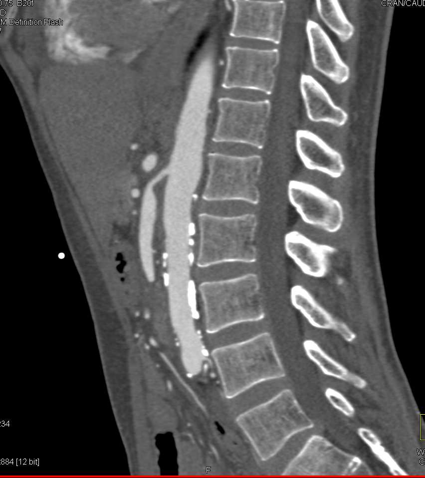 Superior Mesenteric Artery (SMA) Stenosis - CTisus CT Scan