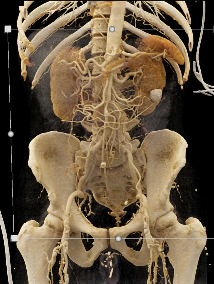 CTA Mapping of Mesenteric Vessels - CTisus CT Scan