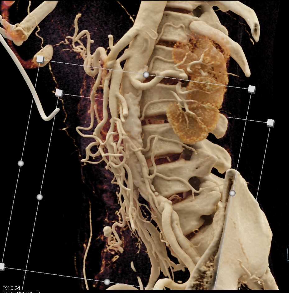 CTA Mapping of Mesenteric Vessels - CTisus CT Scan