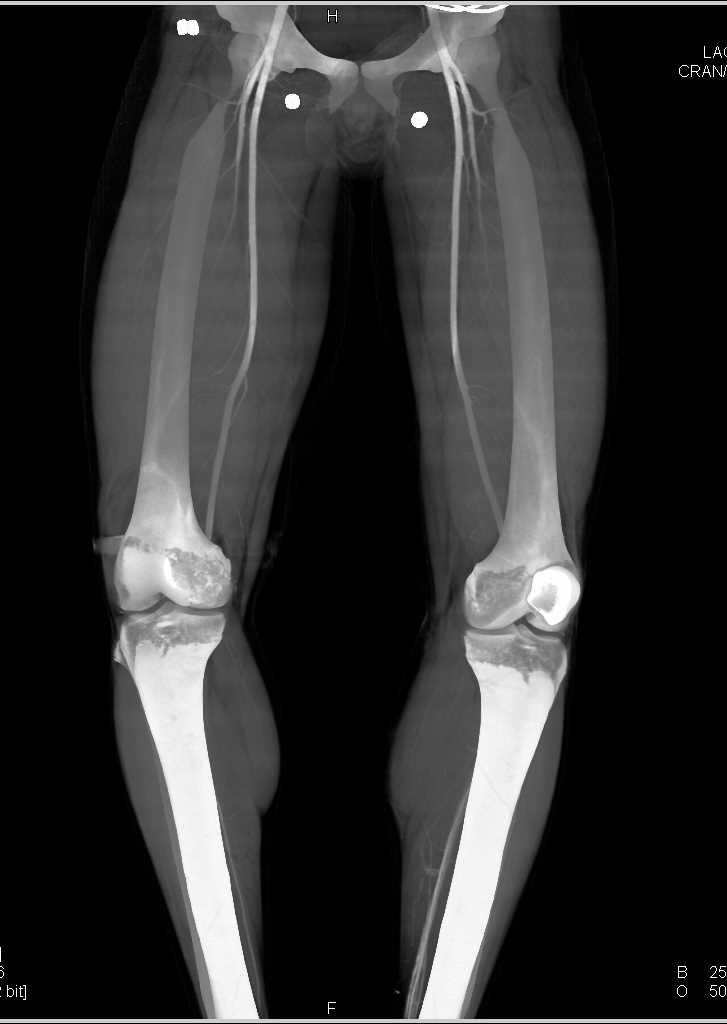 Gunshot Wound (GSW) Thigh Without Vascular Injury with CTA - CTisus CT Scan