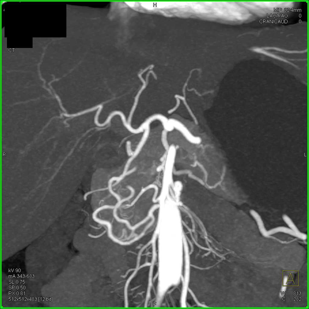 Normal Mesenteric Arcade - CTisus CT Scan