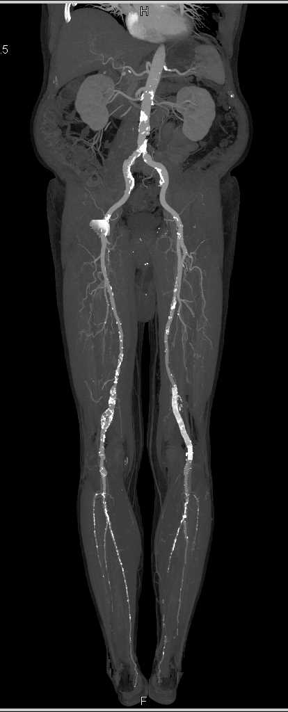 CTA Runoff with Peripheral Arterial Disease (PAD) - CTisus CT Scan