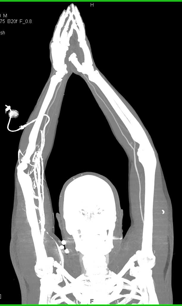 CTA Upper Extremities - CTisus CT Scan