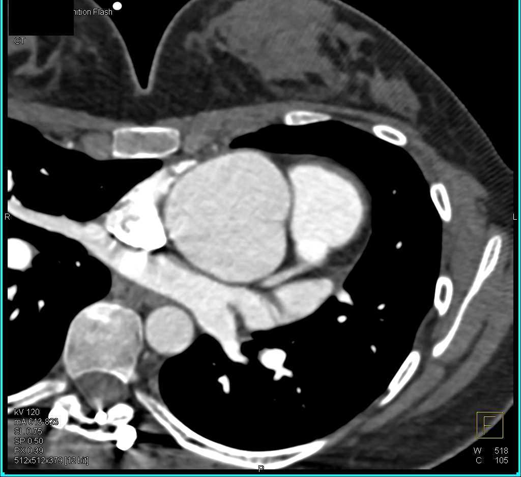 Dilated Aortic Root in Marfans Syndrome - CTisus CT Scan