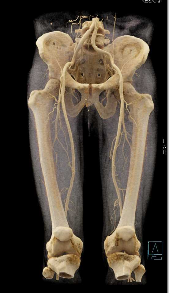 Normal CTA Runoff Thru the Thighs - CTisus CT Scan