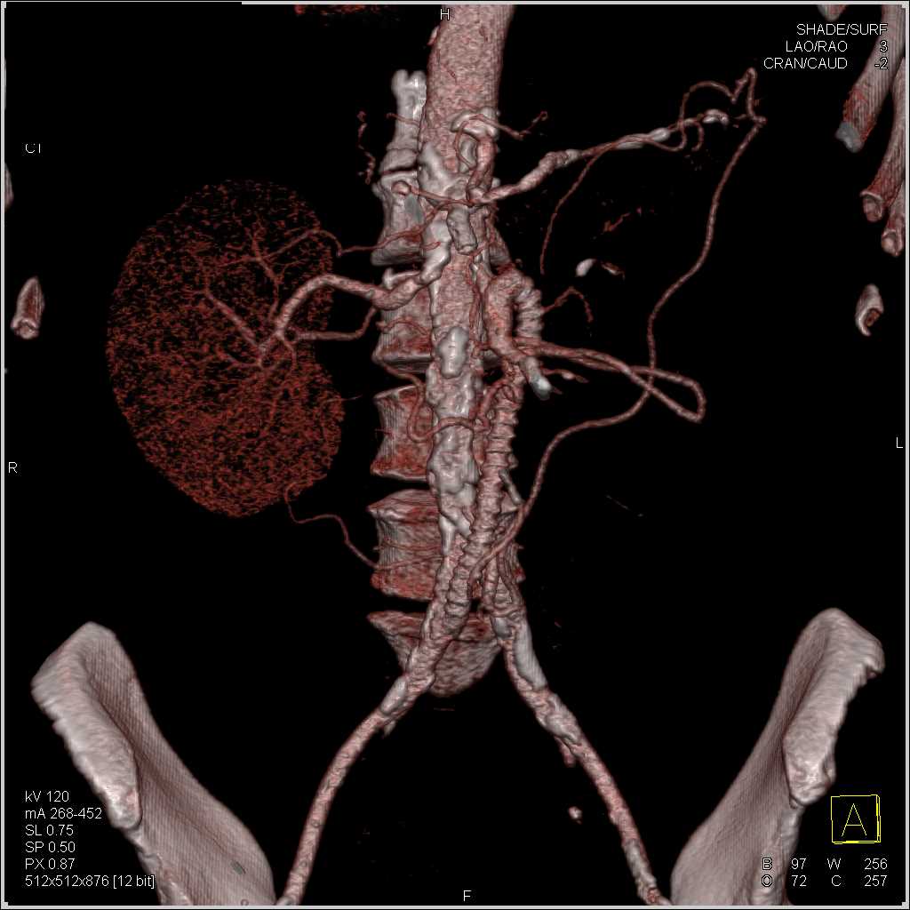 Superior Mesenteric Artery (SMA) Graft Reconstruction - CTisus CT Scan