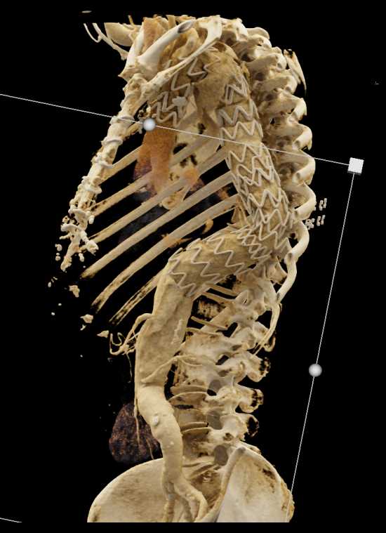 Endovascular Stent Repair with Cinematic Rendering - CTisus CT Scan