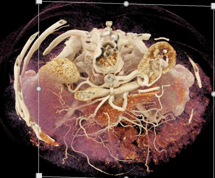 AV Fistulae Left Kidney - CTisus CT Scan