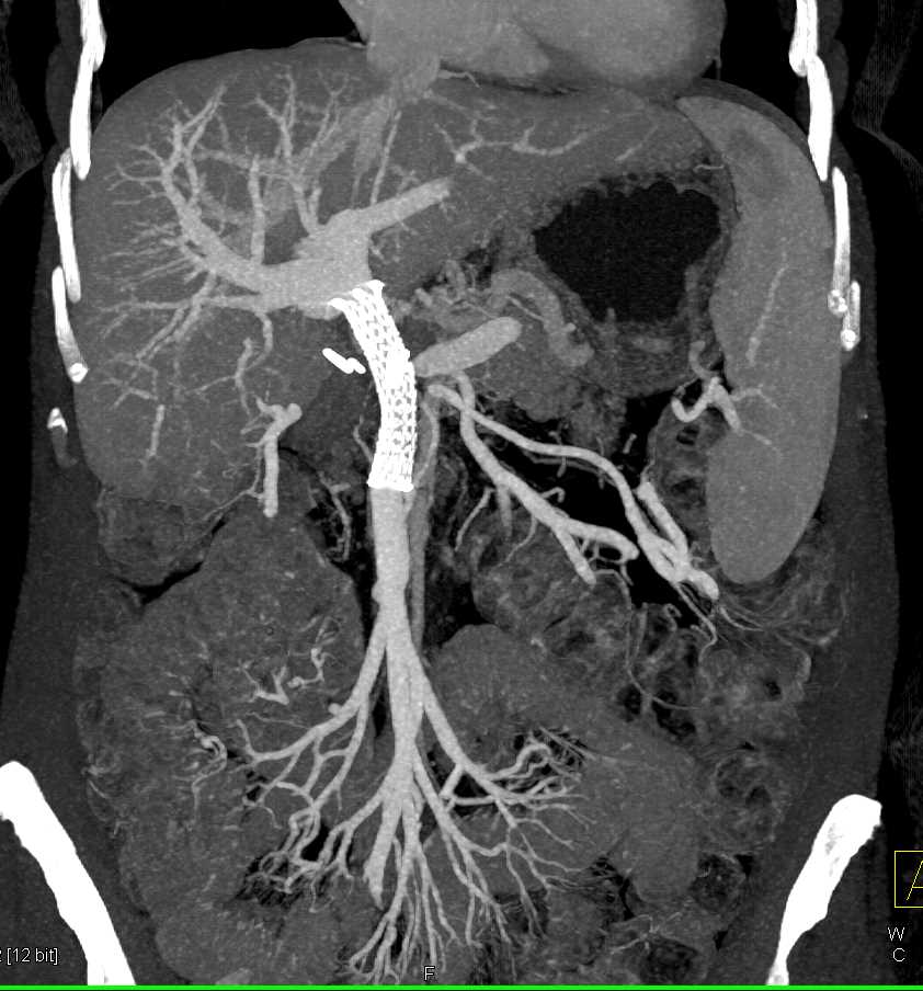 Patent Stent in the Main Portal Vein - CTisus CT Scan