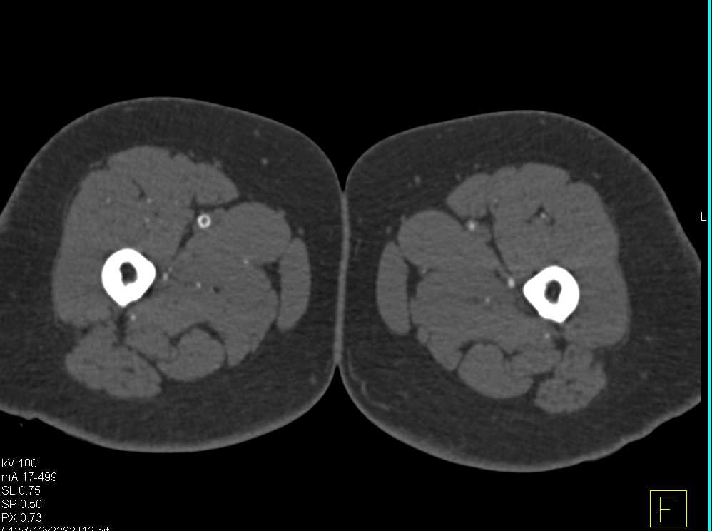 Superficial Femoral Artery (SFA) Stents with Vessel Stenosis - CTisus CT Scan