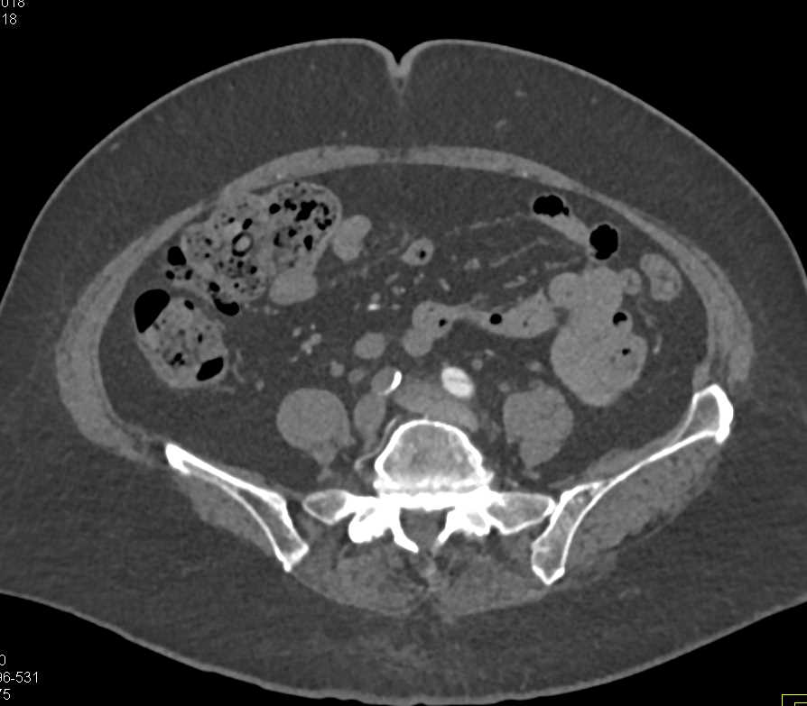 Fem-Fem Bypass Graft - CTisus CT Scan