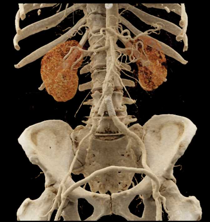 Fem-Fem Bypass Graft - CTisus CT Scan