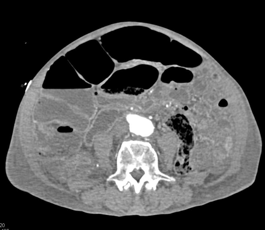 Vasculitis Involves the Superior Mesenteric Artery (SMA) - CTisus CT Scan