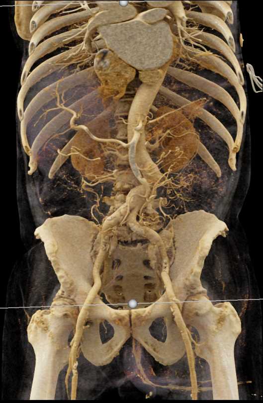 Repair of Infrarenal Abdominal Aorta - CTisus CT Scan