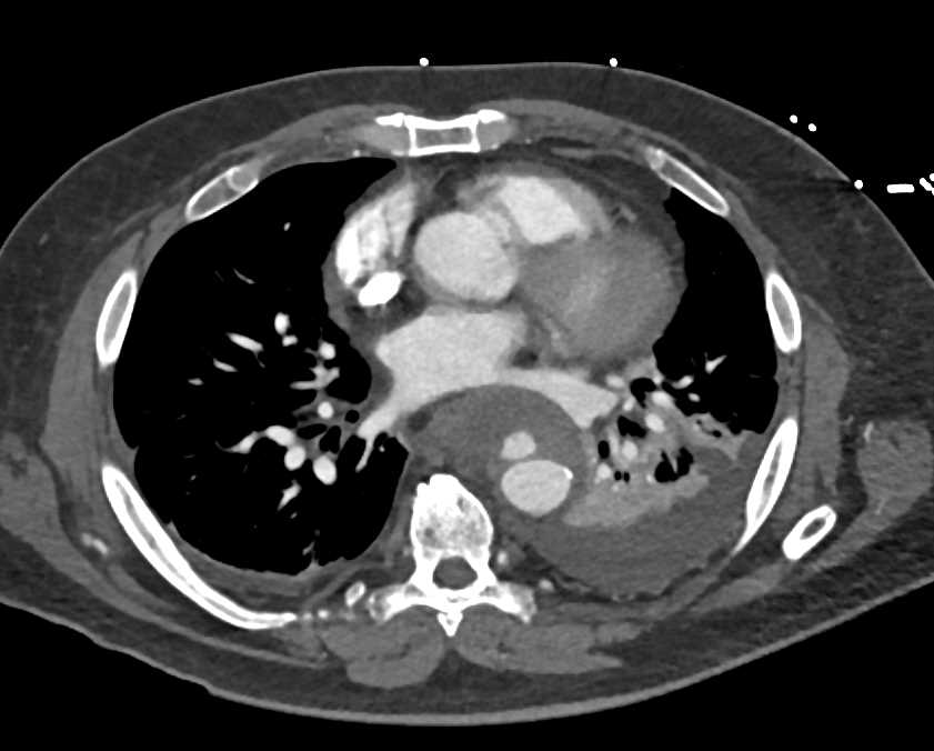 Aortic Ulcer with Intramural Hematoma - CTisus CT Scan