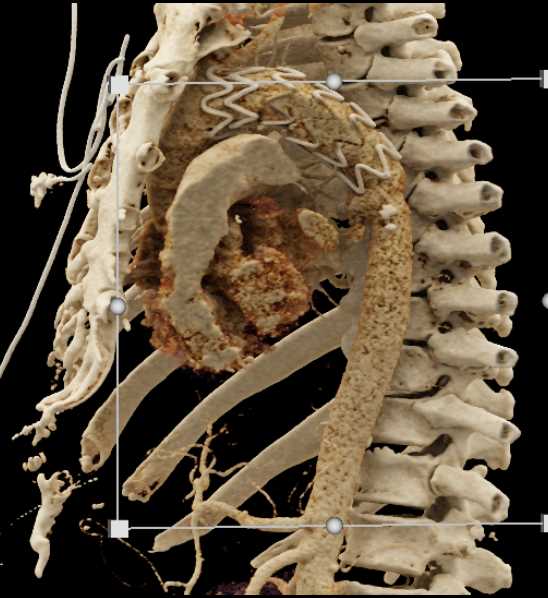 Aortic Ulcer with Intramural Hematoma - CTisus CT Scan