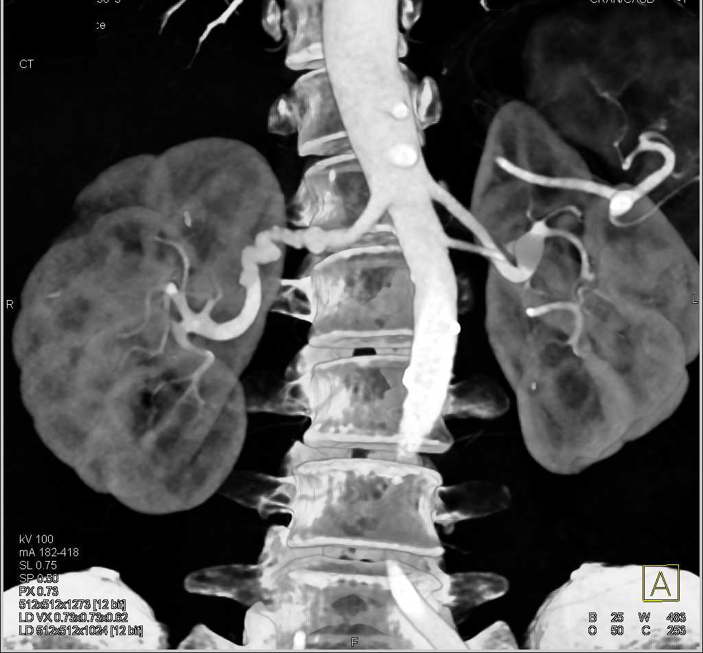 Fibromuscular Dysplasia Involves the Right Renal Artery - CTisus CT Scan