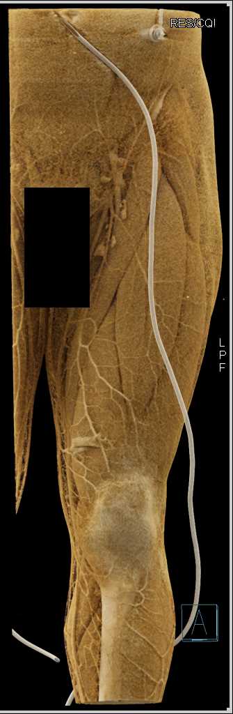 Gunshot Wound (GSW) Without Vascular Injury - CTisus CT Scan