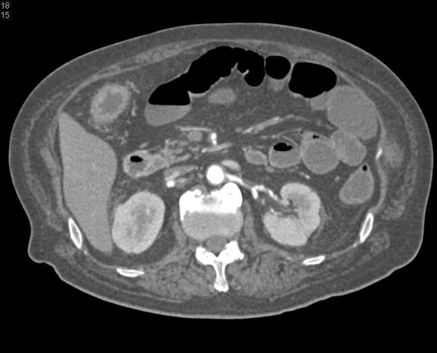 High Grade Stenosis SMA with Ischemic Small Bowel - CTisus CT Scan