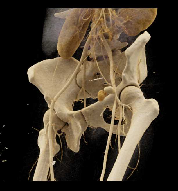 Pseudoaneurysm Left Groin - CTisus CT Scan