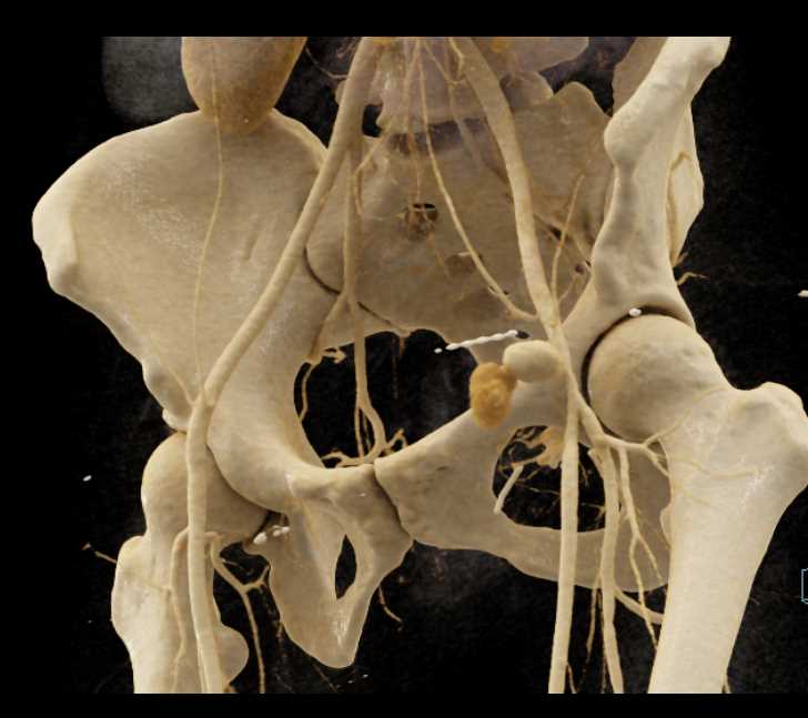 Pseudoaneurysm Left Groin - CTisus CT Scan