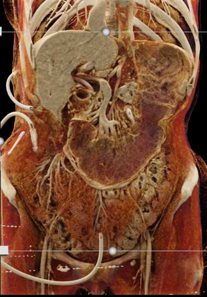 Excellent Vascular Mapping with Cinematic Rendering - CTisus CT Scan