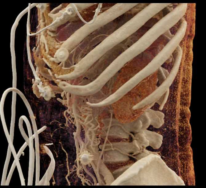 High Grade Celiac and Superior Mesenteric Artery (SMA) Stenosis - CTisus CT Scan