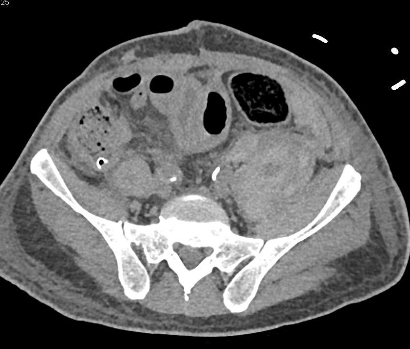 High Grade Celiac and Superior Mesenteric Artery (SMA) Stenosis with Vascular Bypass Grafts - CTisus CT Scan