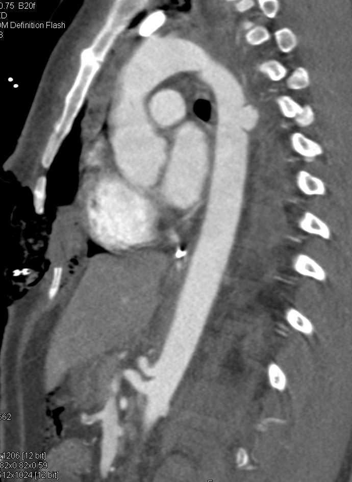 Ulceration Descending Thoracic Aorta - CTisus CT Scan